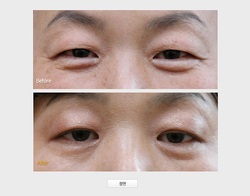 프렉사