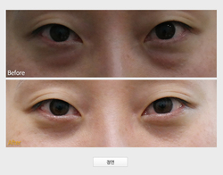 동안성형
